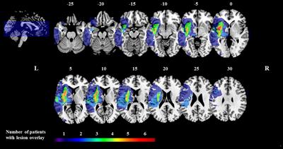 Video-Oculography During Free Visual Exploration to Detect Right Spatial Neglect in Left-Hemispheric Stroke Patients With Aphasia: A Feasibility Study